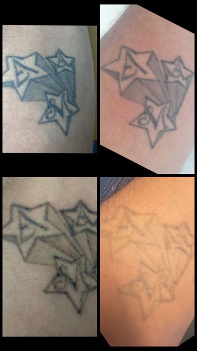 Equipamento de remoção de tatuagem