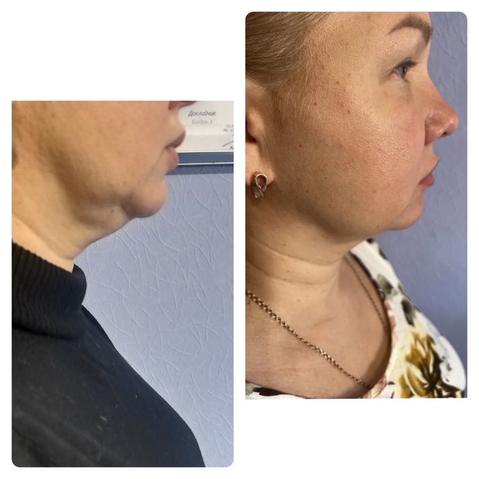 Косметолог чистка пилинг массаж кавитация прессотерапия депиляция