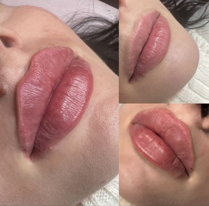 Botox, Powiększanie ust