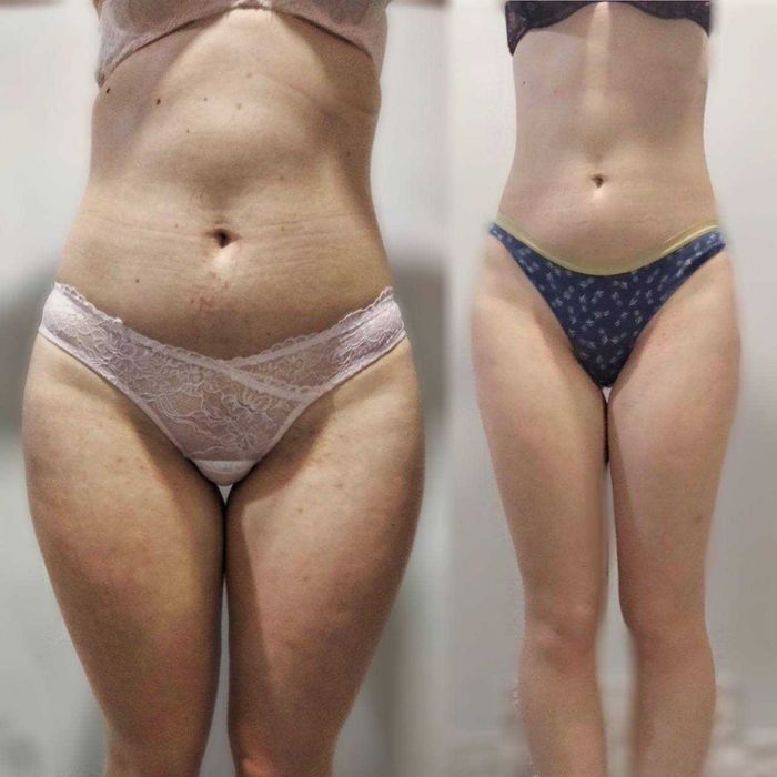 Антицеллюлитный массаж