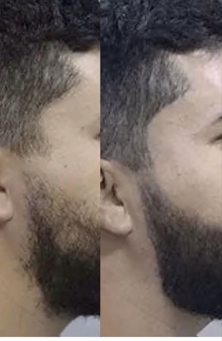 Volte a ter pelos - Sobrancelhas, barba e cabelo