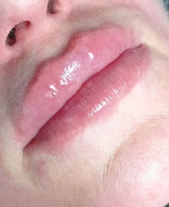 Ботокс, Контурная пластика Услуги косметолога.