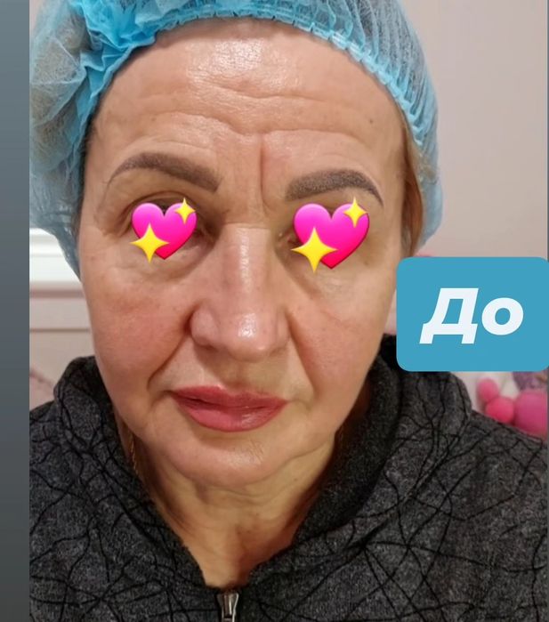 Косметолог Ботокс,  увеличение губ, липолитики