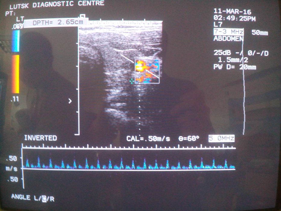 Лінійний датчик УЗД Siemens (Acuson) L7