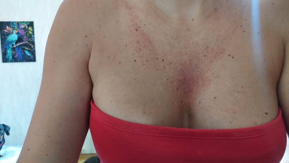 Мезотерапия, фракционная мезо, микронидлинг