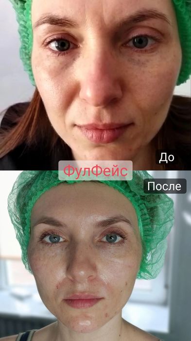 Косметолог- Дерматолог.Ботокс.Контурная пластика. Чистка лица. Массаж