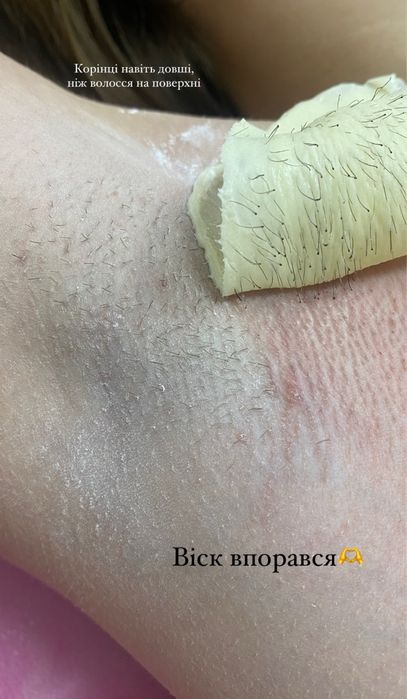 Депіляція чоловіча, жіноча, шугаринг, електроепіляція