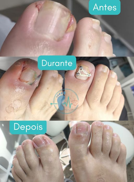 Pedicure avançada profissional