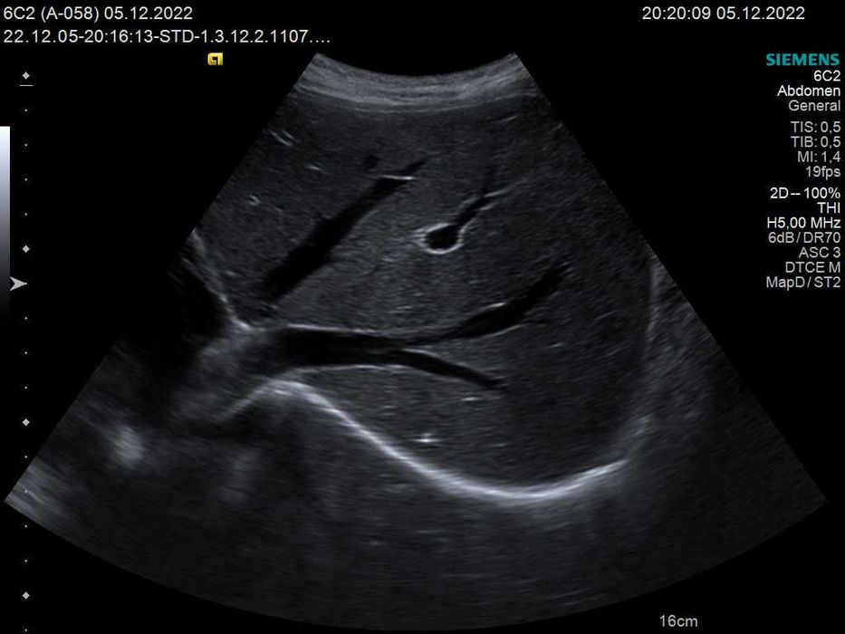 Конвексний датчик УЗД Siemens (Acuson) 6C2