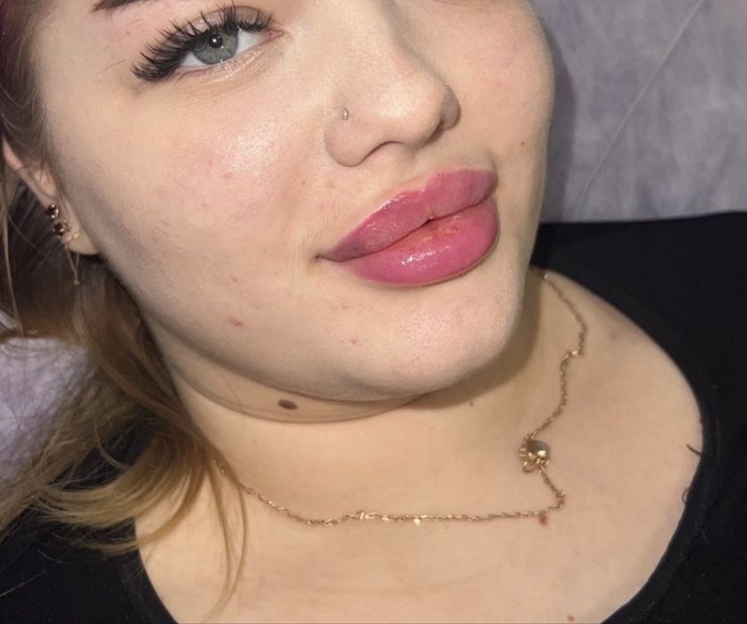 Збільшення губ 1500/3000 | лікар косметолог | моделі