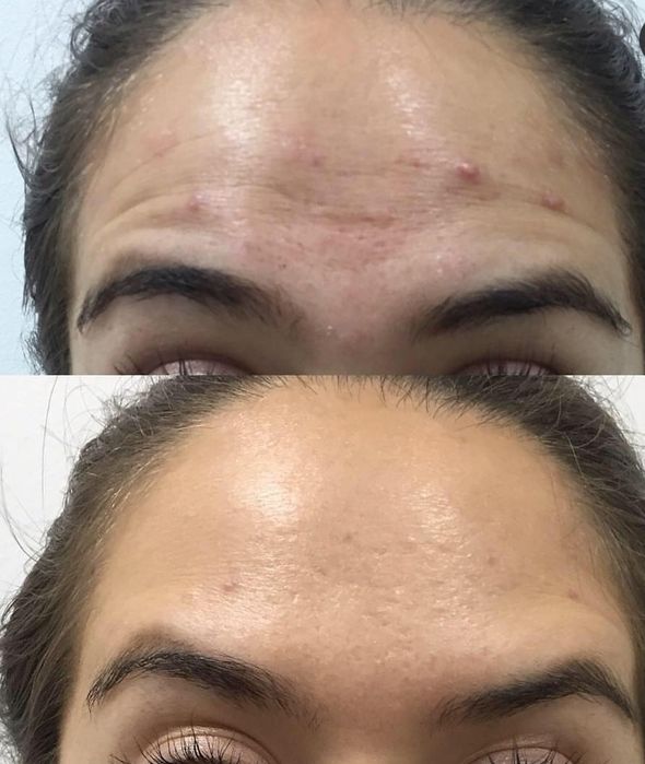 BOTOX DAY 2024 WOLUMETRIA Zabiegi Medycyny Estetycznej Łódź Górna • OLX.pl