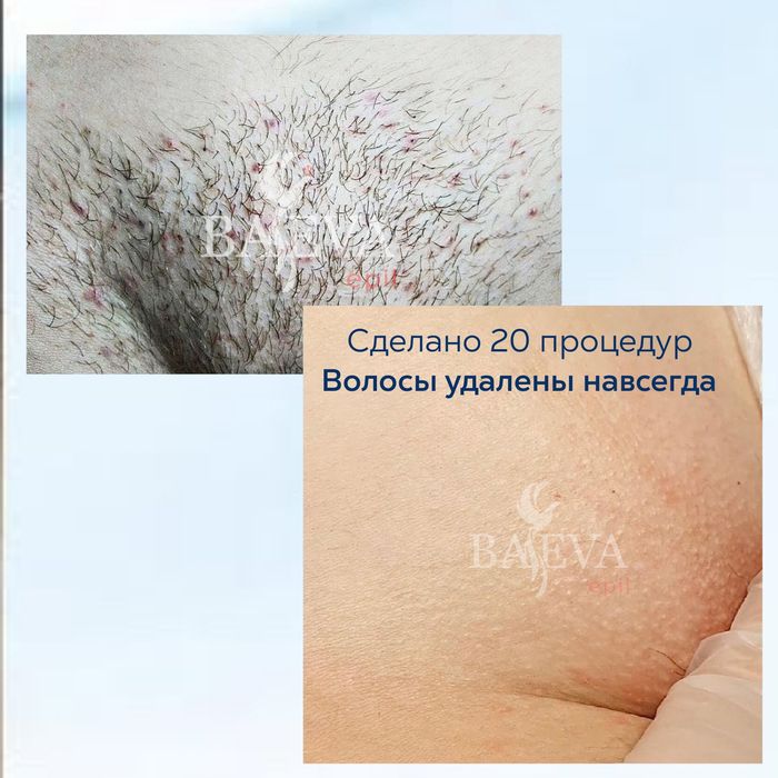 Электроэпиляция. Електроепіляція. Видалення волосся назавжди