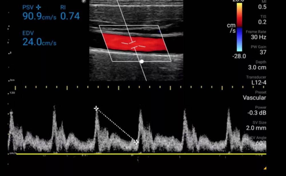 УЗД портативний Philips lumify L12-4
