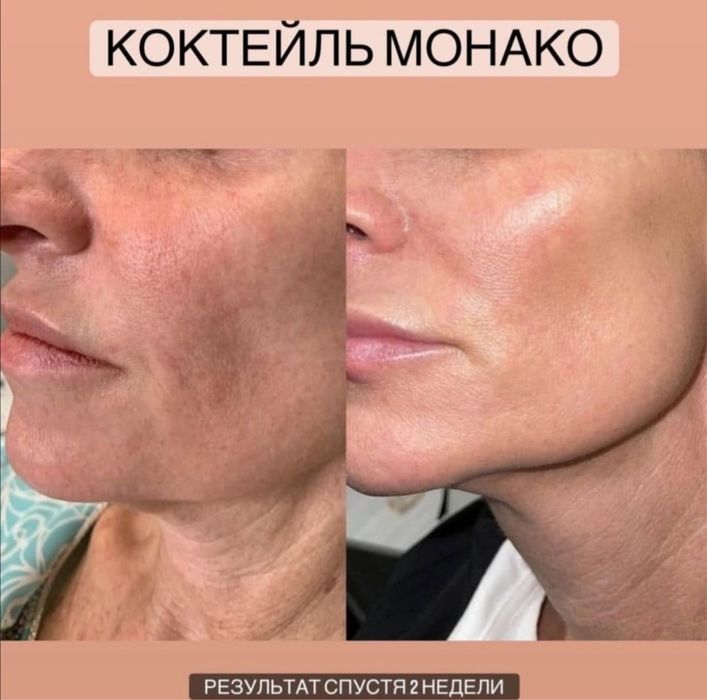 Косметолог. Акция 5 процедур по цене препарата