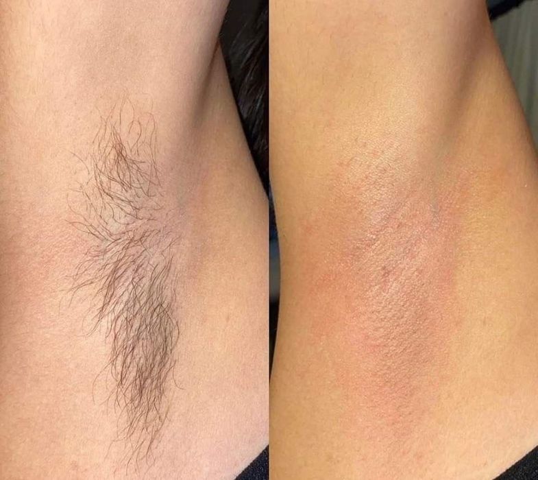 Depilacja męska różna