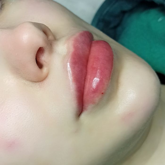 1500 грн губи контурна пластика.Ботокс.