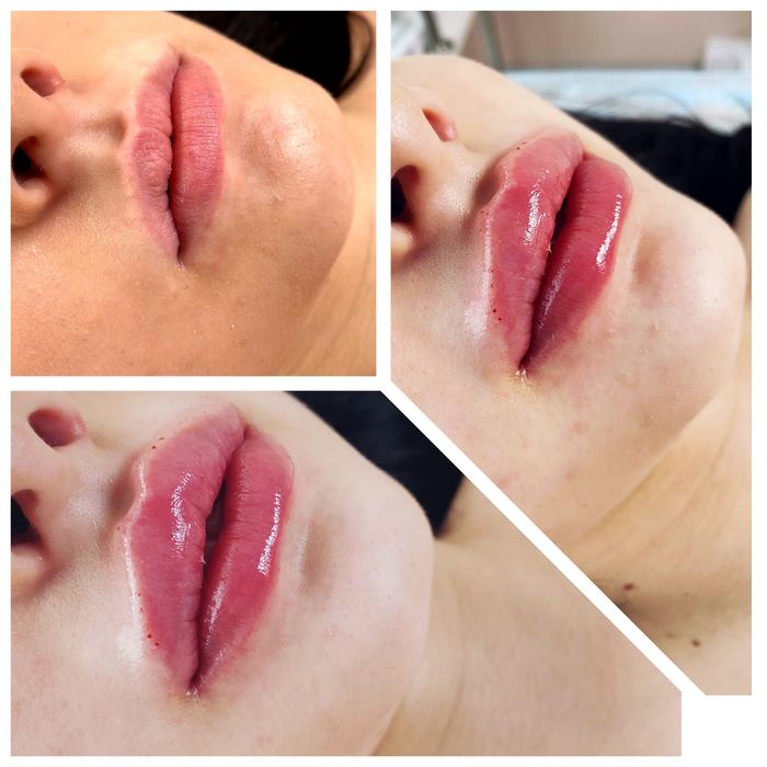 Косметолог ! Інʼєкційні процедури! Запоріжжя!