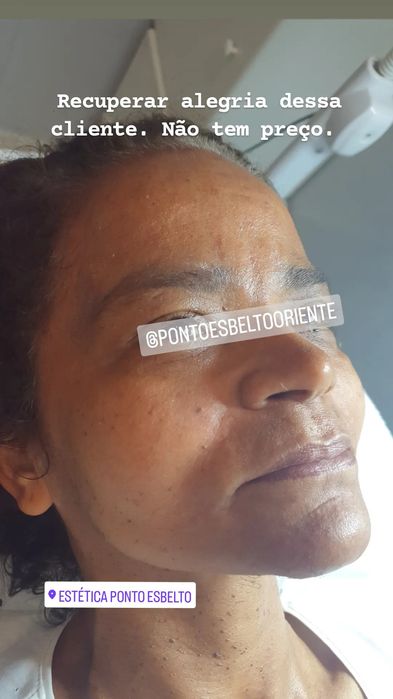 Preenchimento labial e harmonização facial e Lipo enzimática