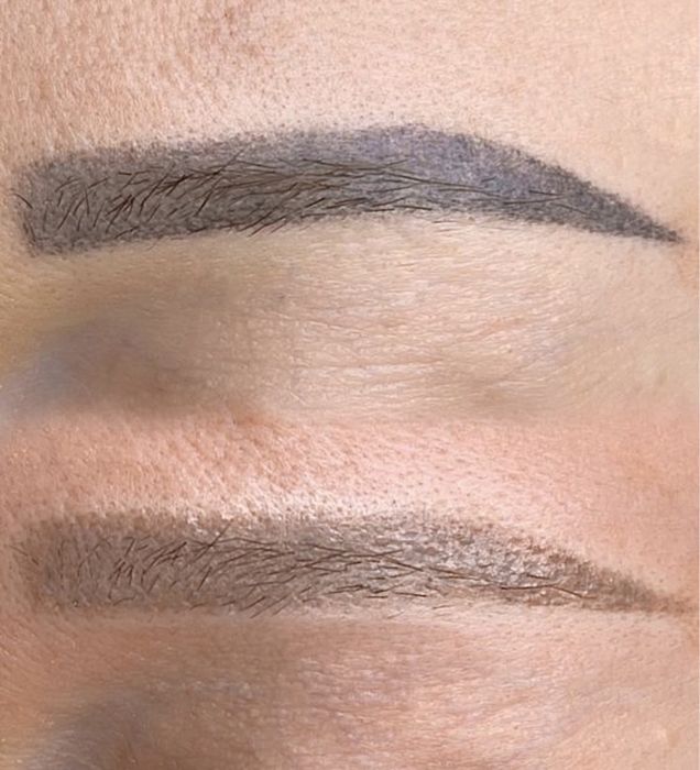 Удаление татуажа Ремувером! Качественно и эффективно!