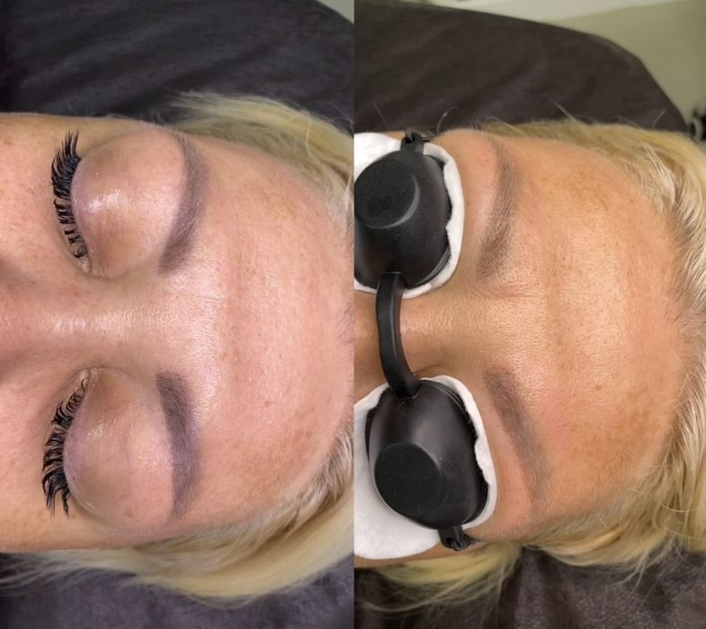 Видалення татуажа тату перманента лазером бровей стрелок губ ремувер