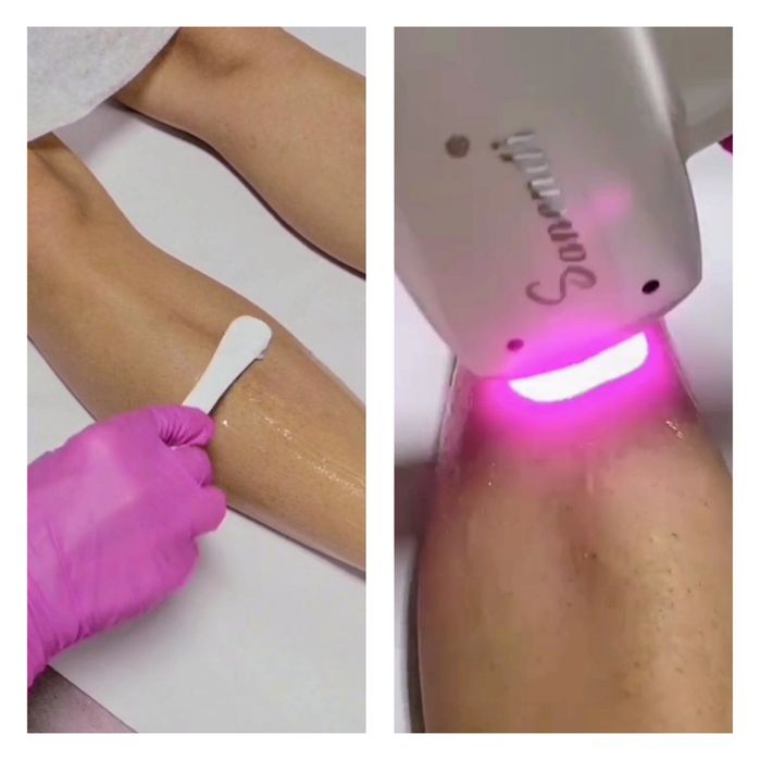 Alugo máquina NOVA de depilação a laser