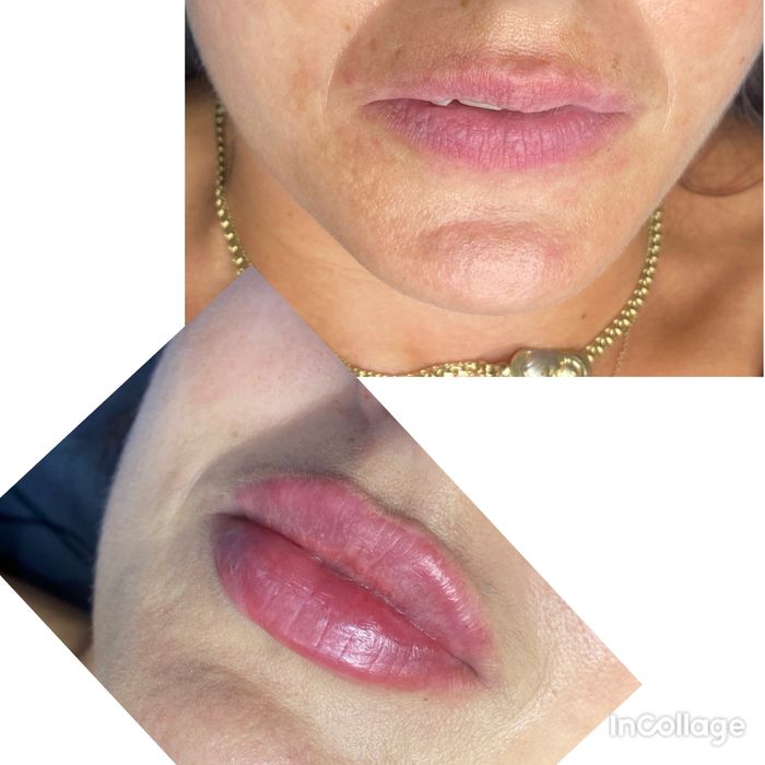 Modelowanie ust, botox ,nici, stymulatory, lipoliza !