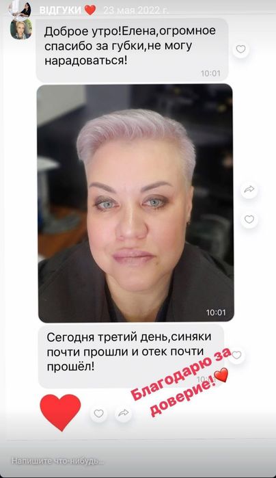 Збільшення губ, ботокс, біоревіталізація