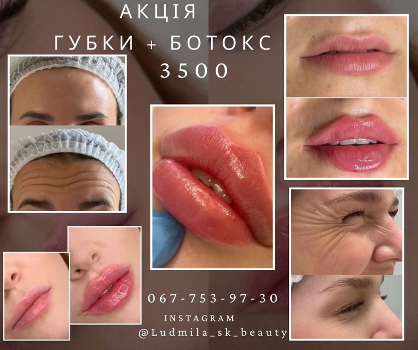 МОДЕЛЬ  Губи (1500 грн )  Київ - Ірпінь