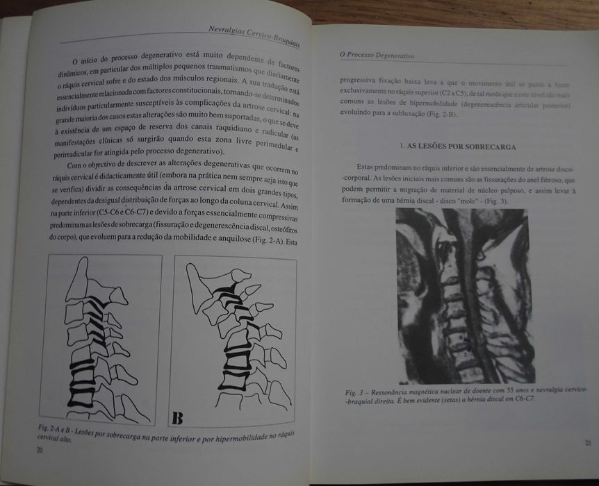 Nevralgias Cervico-Braquiais (Monografia) de Filipe Duarte e Rui Vaz