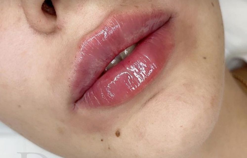 АКЦИЯ!!! Увеличение губ 1700 грн. Колличество мест ограничено!