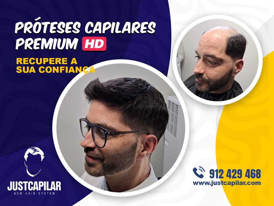 Prótese Capilar Micro Pele com Colocação e Corte, efeito real e imediato, em 2 horas volte a sorrir!