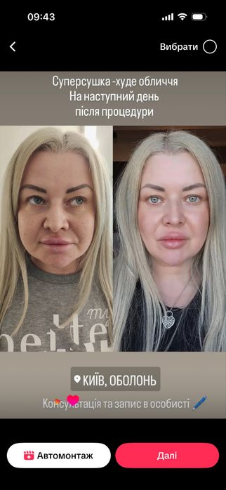 Косметолог моделі на(губи,ботокс,смас,рф голка,схуднення,худе обличчя)