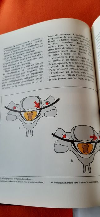 Przepuklina dyskową i artrozy kręgosłupa