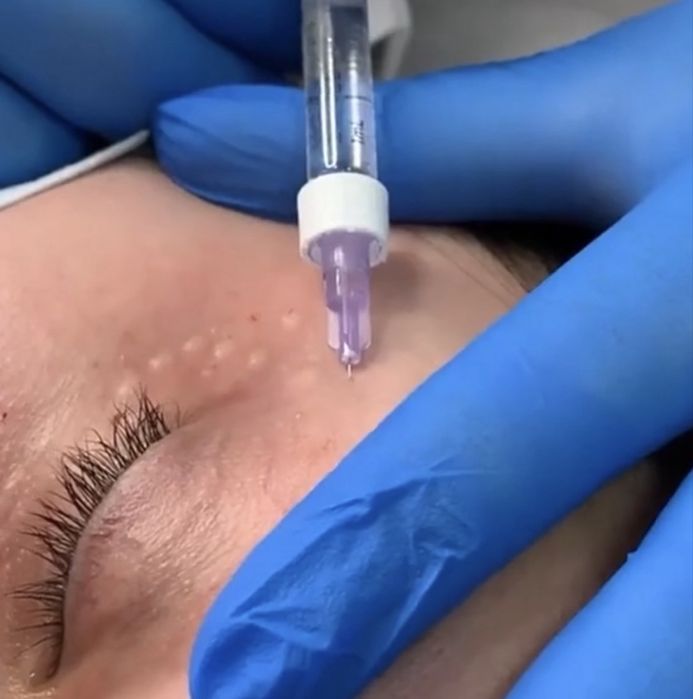 Збільшення губ 1500/3000 | лікар косметолог | моделі