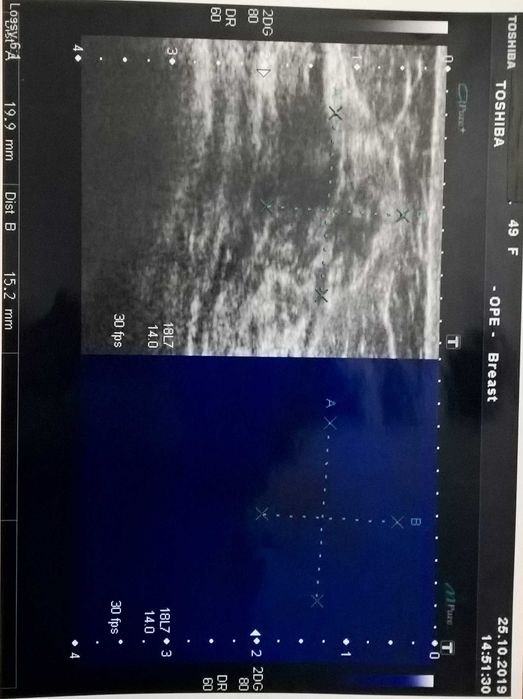 Аппарат УЗИ экспертного класса - Toshiba APLIO MX