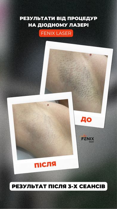 Лазерна епіляція Дніпро(лівий берег)