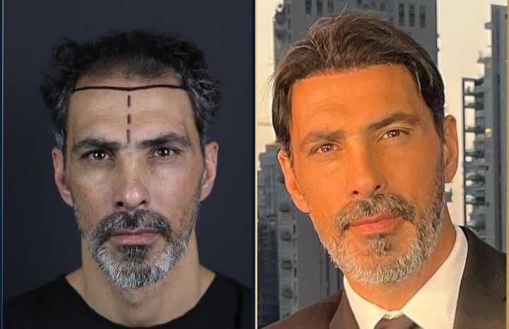 Transplante Capilar/Barba Istambul(Turquia) 2950€ TUDO INCLUIDO