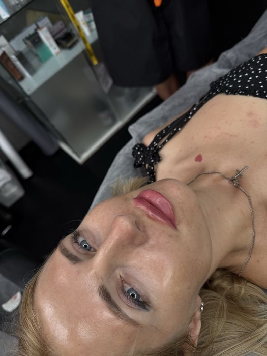 Увеличение губ и ботокс