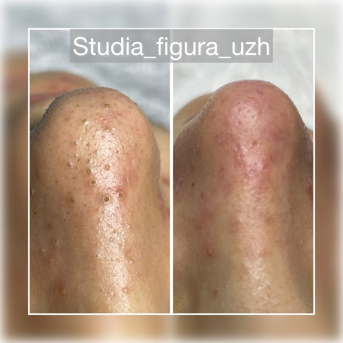 Чистка обличчя, УЗ чистка, механічна. Пілінг. Електропорація