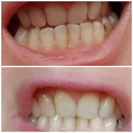 Pasta de dentes branqueadora incluindo transporte