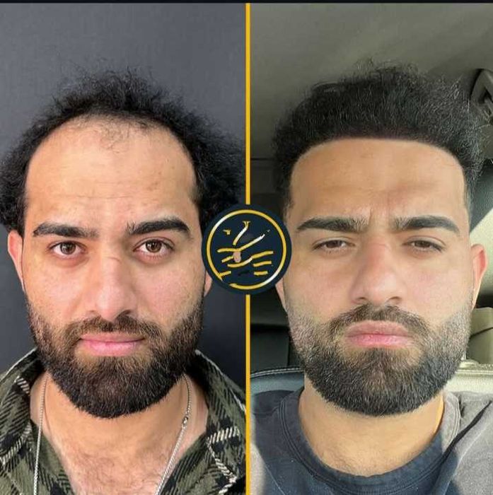 Transplante Capilar/Barba Istambul(Turquia) 2950€ TUDO INCLUIDO