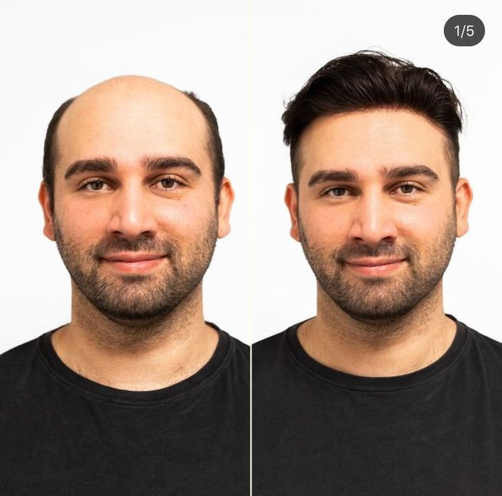 Curso Profissional de prótese capilar injetada em Alverca