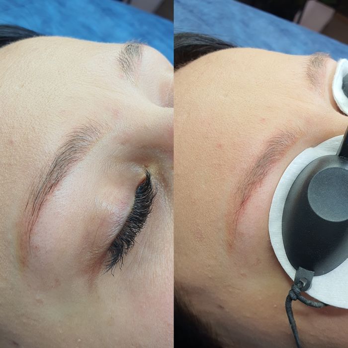 Удаление тату, Удаление татуажа, удаление перманента