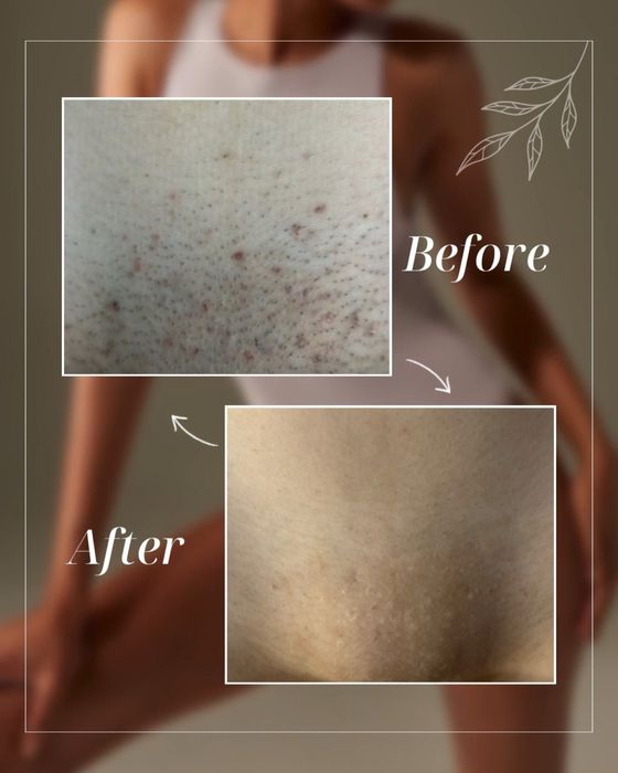 Лазерна епіляція в Запоріжжі — гладка шкіра надовго