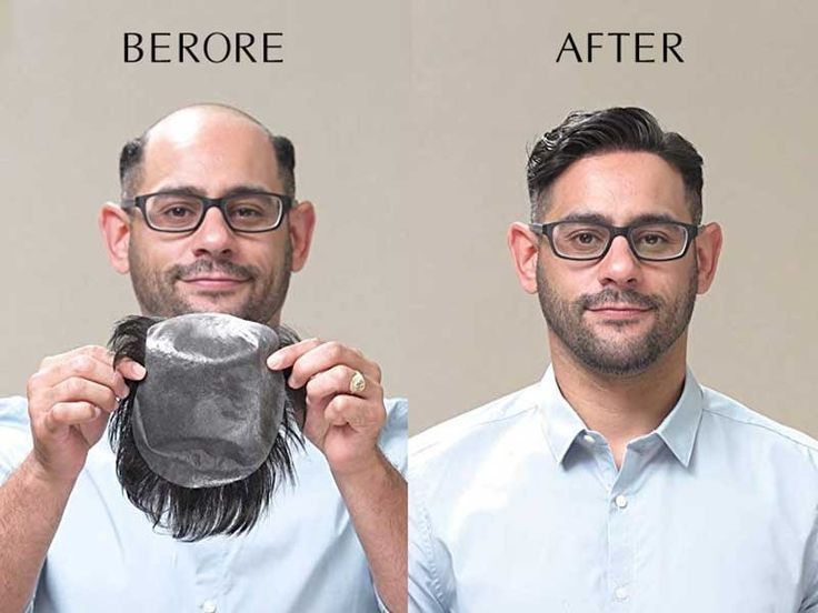 Prótese capilar em Alverca