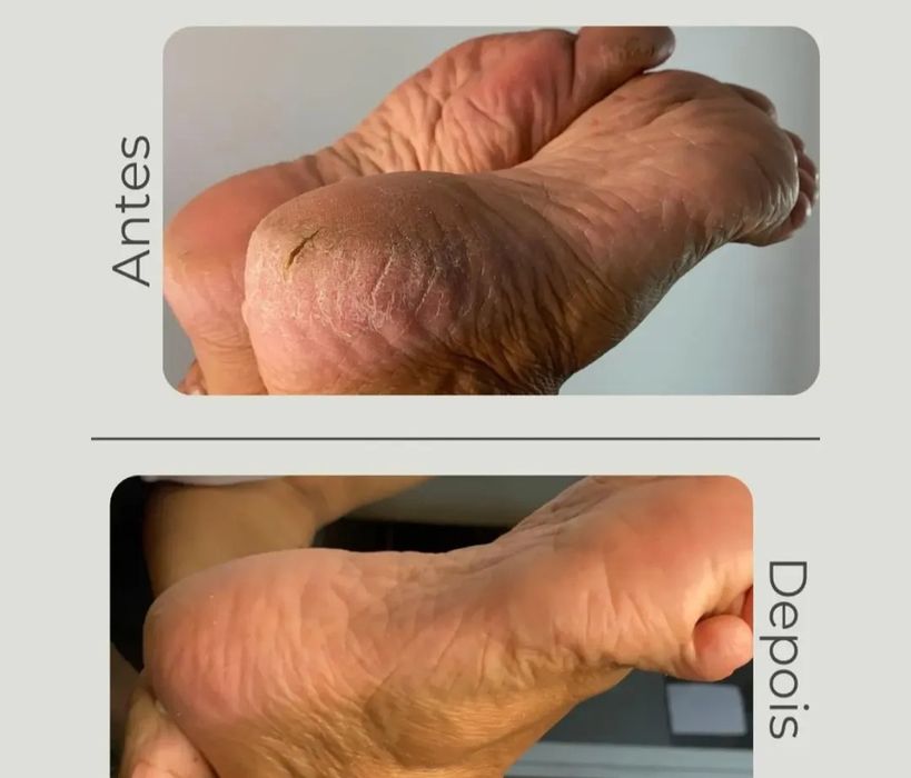 Pedicure avançada profissional
