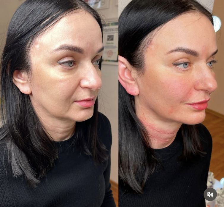 Ботокс. Контуринг. Увеличение губ. Нитевой лифтинг.Биоревитализация