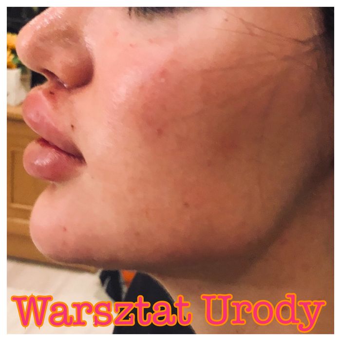 -50% POWIĘKSZANIE UST botox btx kwas hialuronowy NICI HACZYKOWE