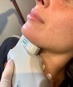 HIFU Facial    pontinha