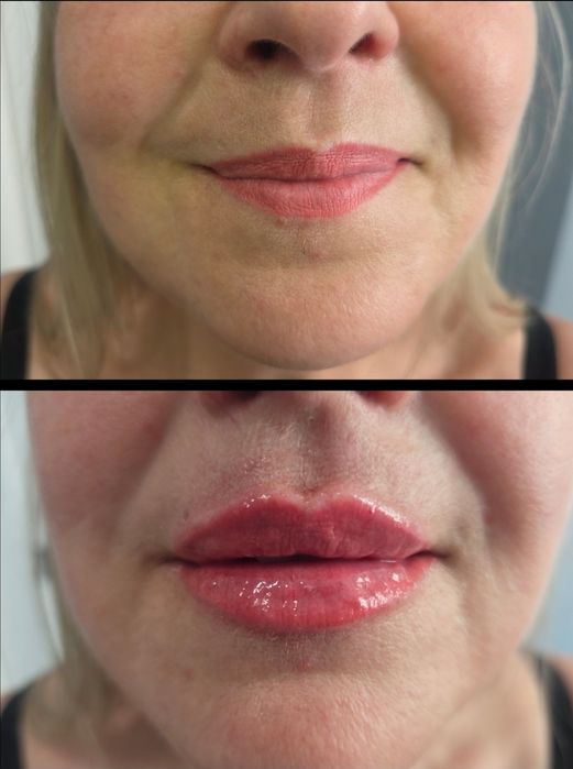 Promocja botox 1 okolica 150zł , usta 370